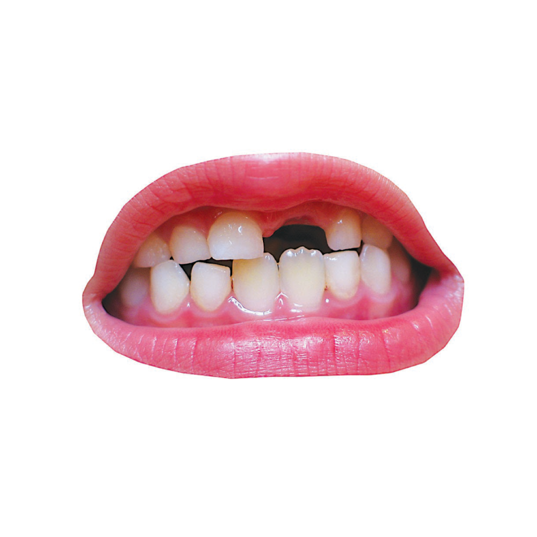 Lips Missing Teeth